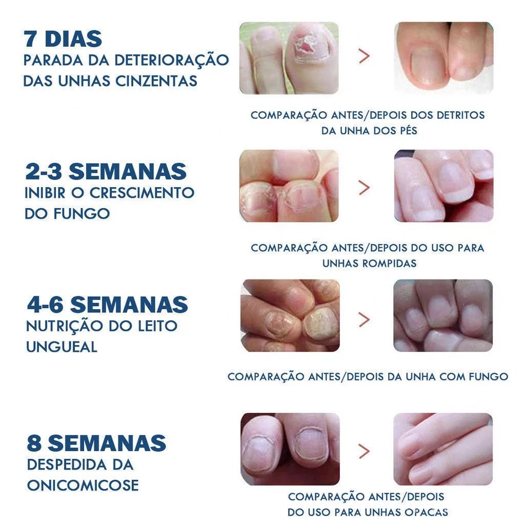 Adesivo para Tratamento de Fungos nas Unhas - Patch de Reparação Noturna (32 Unidades)