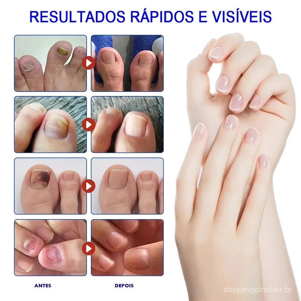 Adesivo para Tratamento de Fungos nas Unhas - Patch de Reparação Noturna (32 Unidades)
